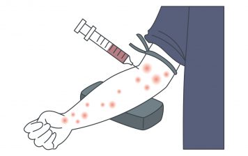 アトピー 注射
