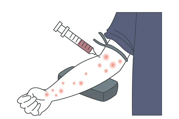 アトピーの注射治療の効果と費用を解説！副作用や治療の進め方も紹介!?